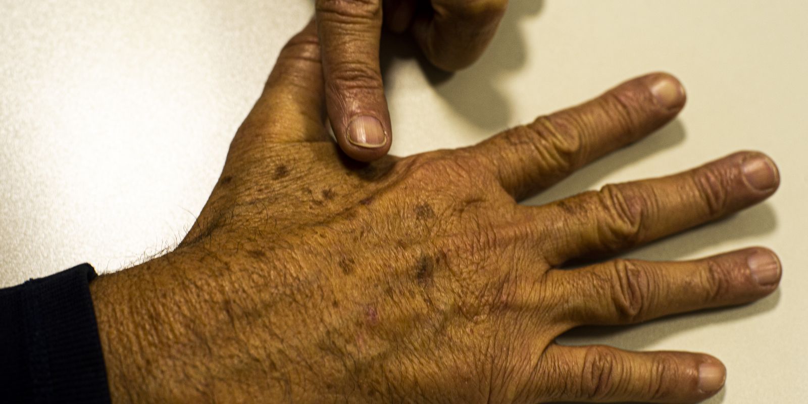 Falta de dados sobre câncer de pele prejudica diagnósticos, aponta fundação
