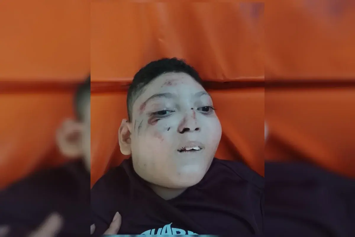 Criança em cadeira de rodas fica ferida após acidente no Metrô-DF