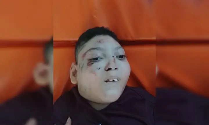 Menino cadeirante cai em escada rolante e sofre acidente no Metrô-DF